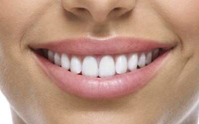 25% de descuento en tratamientos de blanqueamiento dental